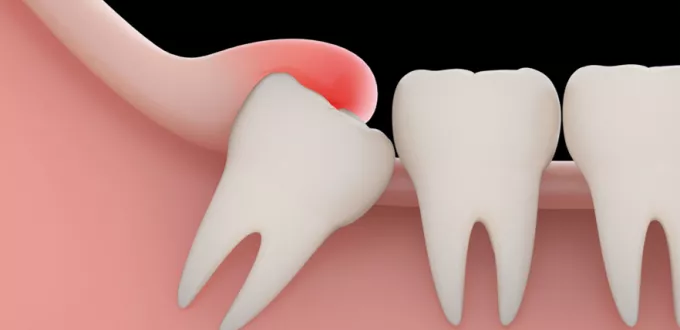 ضرس العقل المدفون ومعلومات هامة عنه