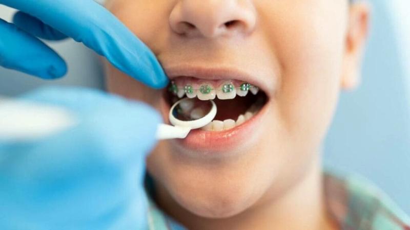 تقويم الأسنان وكل ماتحتاج معرفته عنه