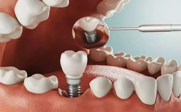 دعامات الأسنان وأنواعها
