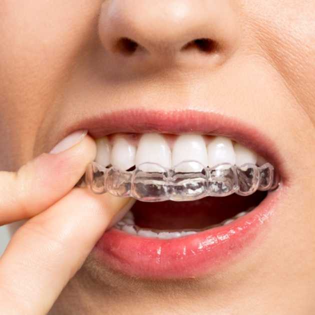التقويم الشفاف المتحرك أو الثابت ومعلومات هامة عنه