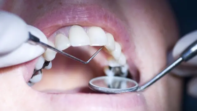 موت عصب السن وأسبابه