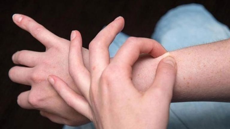 السنط في الجلد وطرق الوقاية منه