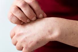 أسباب تكون الورم الوعائي الكرزي