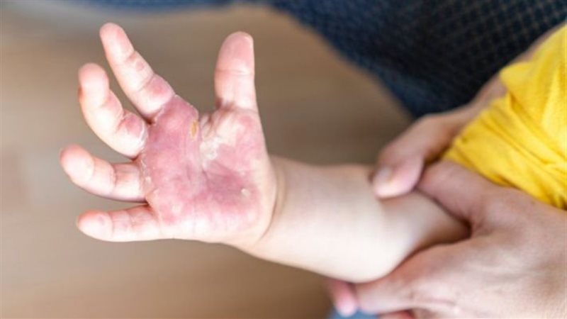 حروق الأطفال وطرق التعامل معها