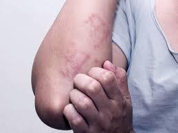 التهاب الجلد الفطري وطرق الوقاية منه