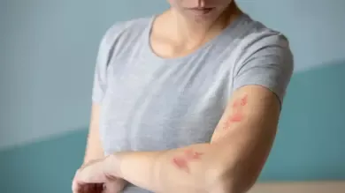 جدري الماء والحزام الناري والفرق بينهم