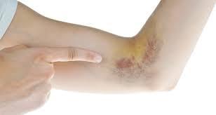 النزيف الداخلي وأسبابه