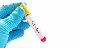 تحليل CRP للأطفال ومعلومات هامة عنه