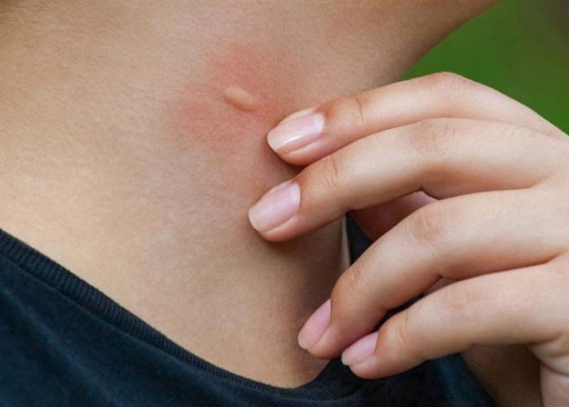 مرض الملاريا ومعلومات هامة عنه