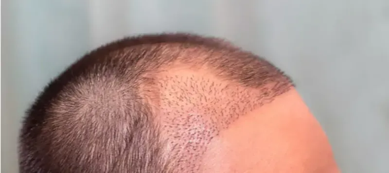 عمليات زراعة الشعر لعلاج الصلع