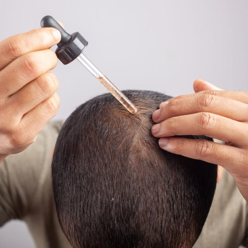 مينوكسيديل (Minoxidil) وأعراضه الجانبية
