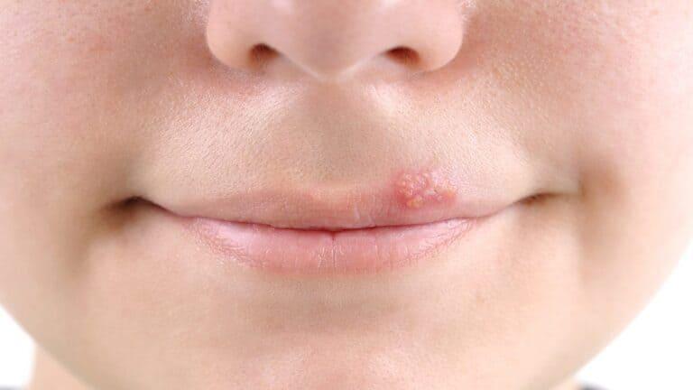 مضاعفات داء كثرة الوحيدات