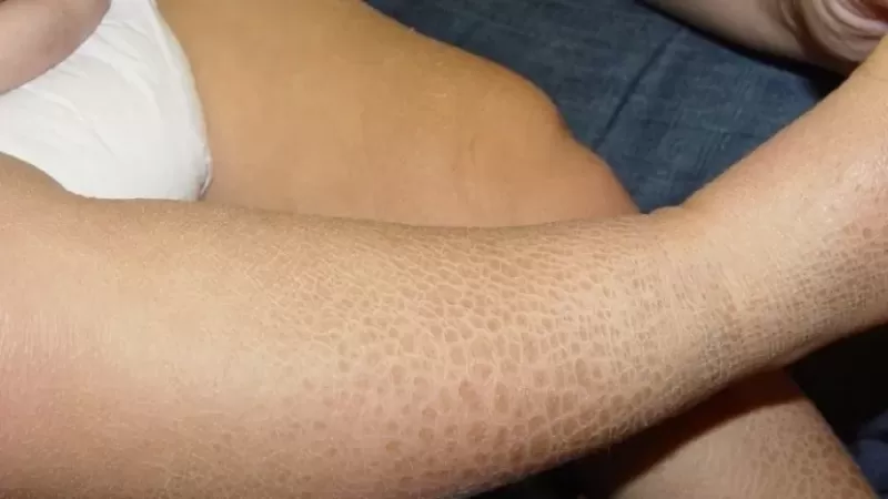 طرق الوقاية مرض السماك