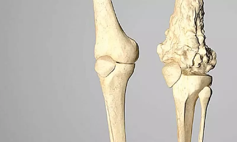 الورم الحميد فى العظم