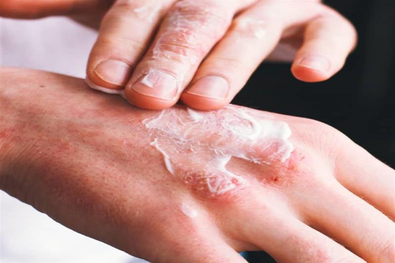 طرق الوقاية من مرض البلاغرة