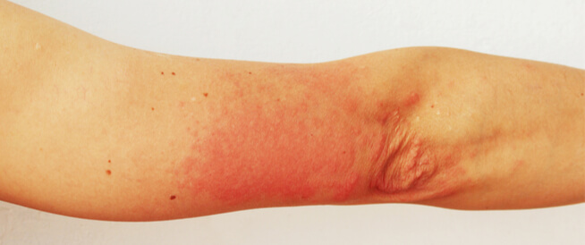 تشخيص واعراض مرض الحمامى العقدية